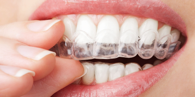 Invisalign Şeffaf Plaklar ile Ortodonti Tedavisi