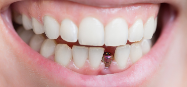 implant fiyatları