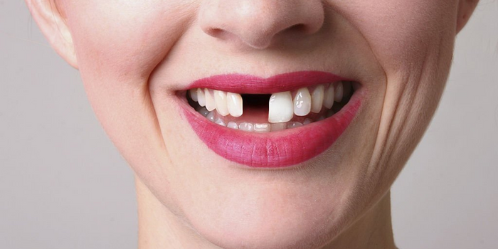 What Happens If You Don’t Replace Missing Teeth?   