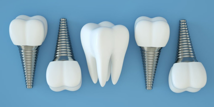 Choosing the Best Dental Implant Brand for Your Needs 