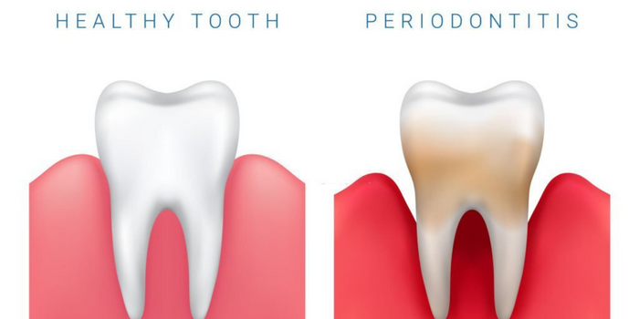 Periodontitis Treatment for Healthy Gums and Strong Teeth 