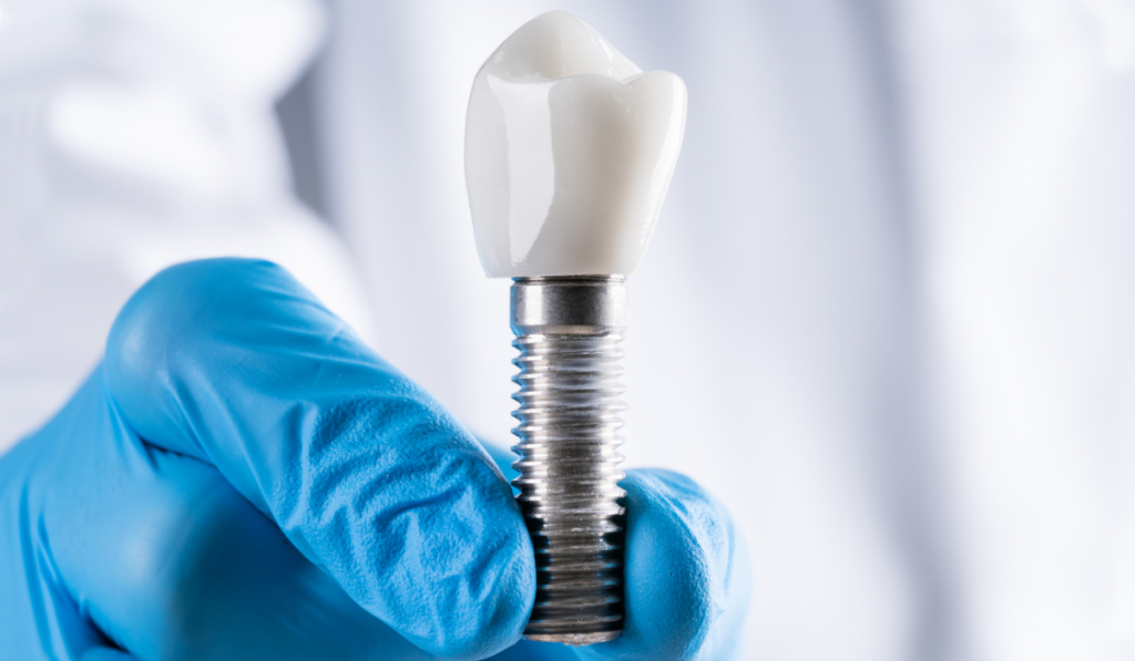 Common Myths About Dental Implants: Debunking Misconceptions