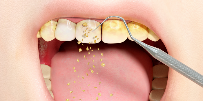 Plaque Removal Made Easy: Tips and Tricks for a Brighter Smile